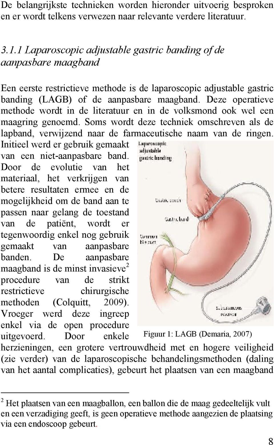 Deze operatieve methode wordt in de literatuur en in de volksmond ook wel een maagring genoemd.