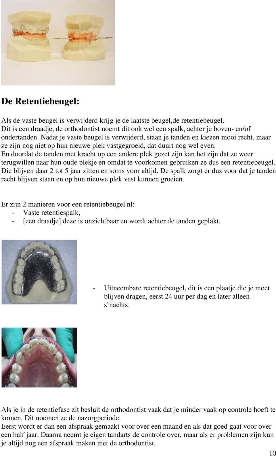 En doordat de tanden met kracht op een andere plek gezet zijn kan het zijn dat ze weer terugwillen naar hun oude plekje en omdat te voorkomen gebruiken ze dus een retentiebeugel.