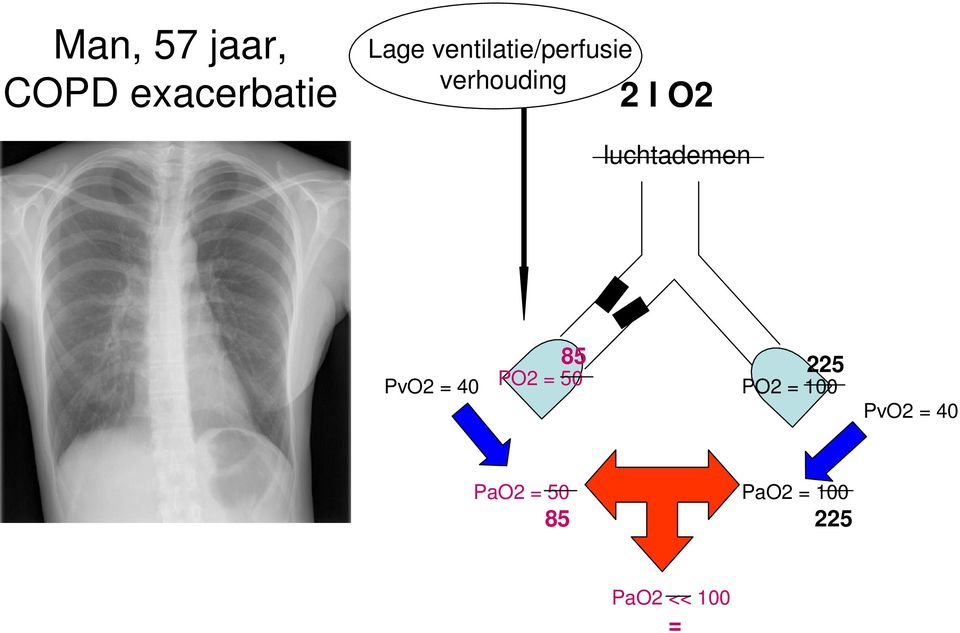 luchtademen PvO2 = 40 85 PO2 = 50 225 PO2 =