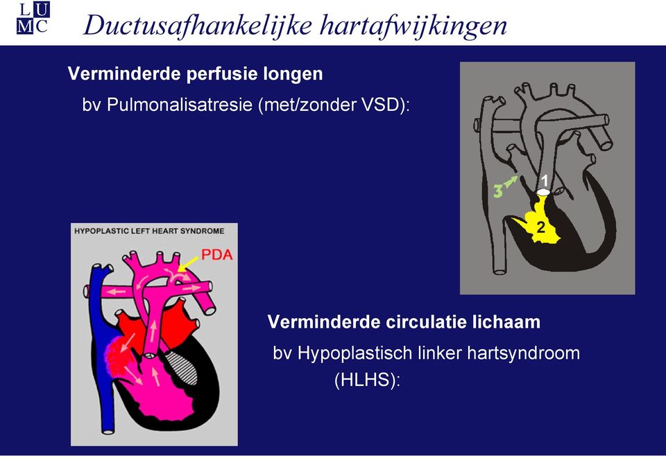 Pulmonalisatresie (met/zonder VSD):