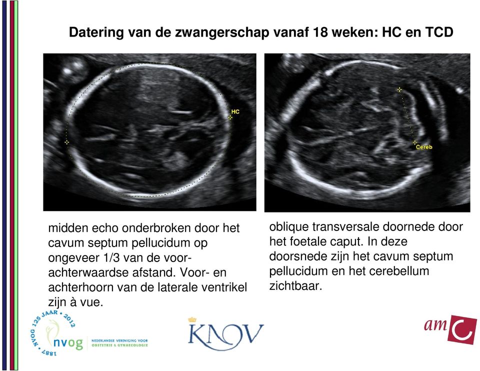 Voor- en achterhoorn van de laterale ventrikel zijn à vue.