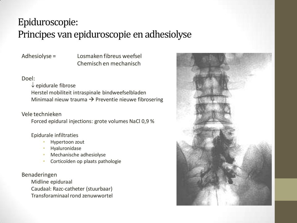 Forced epidural injections: grote volumes NaCl 0,9 % Epidurale infiltraties Hypertoon zout Hyaluronidase Mechanische