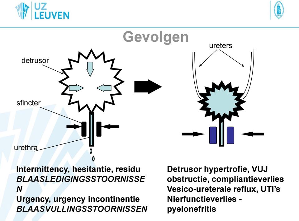 BLAASVULLINGSSTOORNISSEN Detrusor hypertrofie, VUJ obstructie,