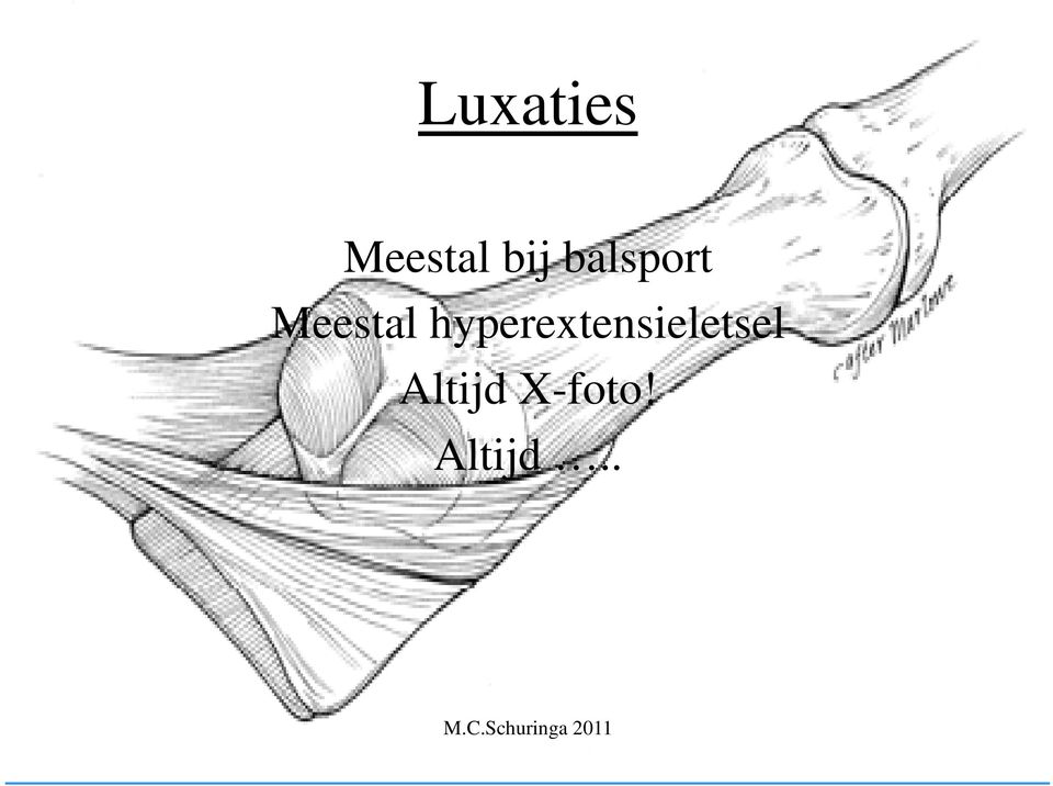 hyperextensieletsel