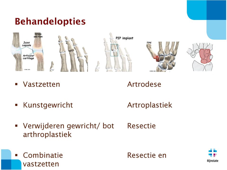 Verwijderen gewricht/ bot