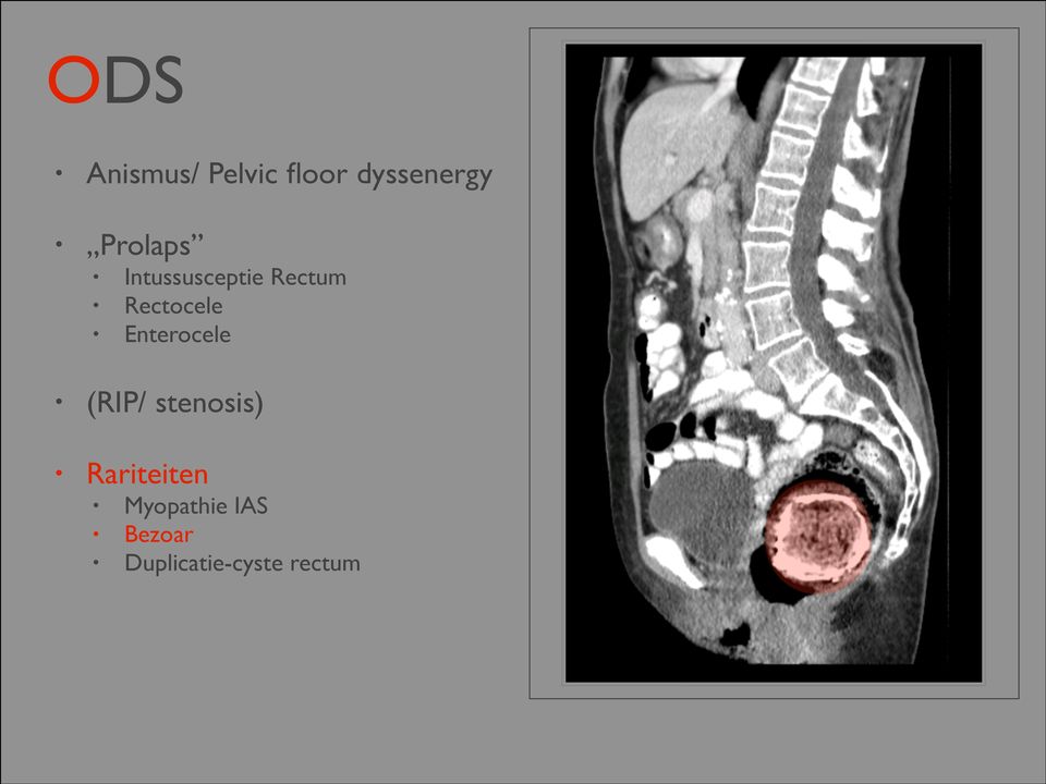 Enterocele (RIP/ stenosis) Rariteiten