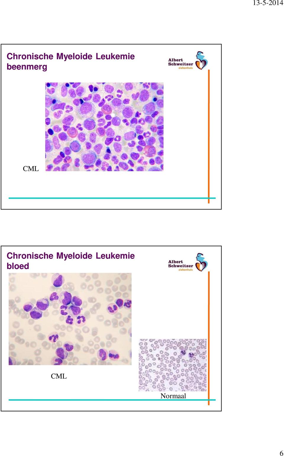 Leukemie bloed CML