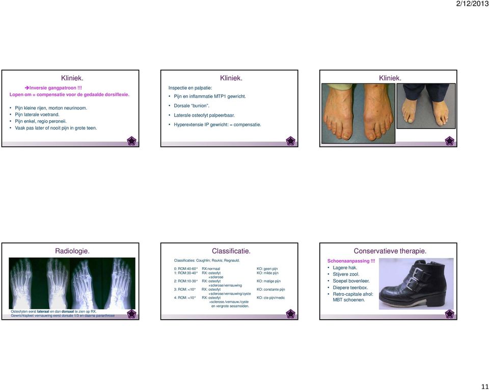 Kliniek. Radiologie. Osteofyten eerst lateraal en dan dorsaal te zien op RX. Gewrichtspleet vernauwing eerst dorsale 1/3 en daarna panarthrose Classificatie.