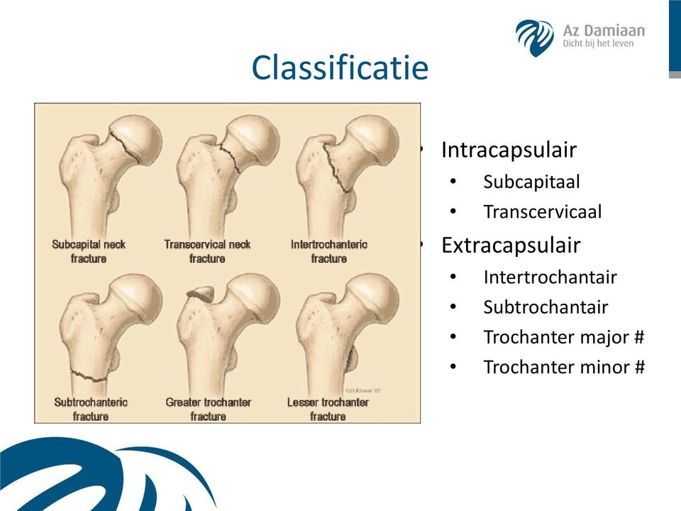 Extracapsulair Intertrochantair