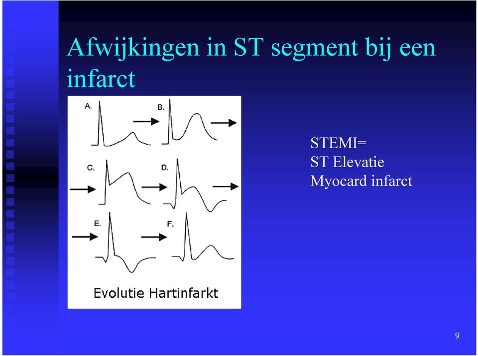 infarct STEMI=