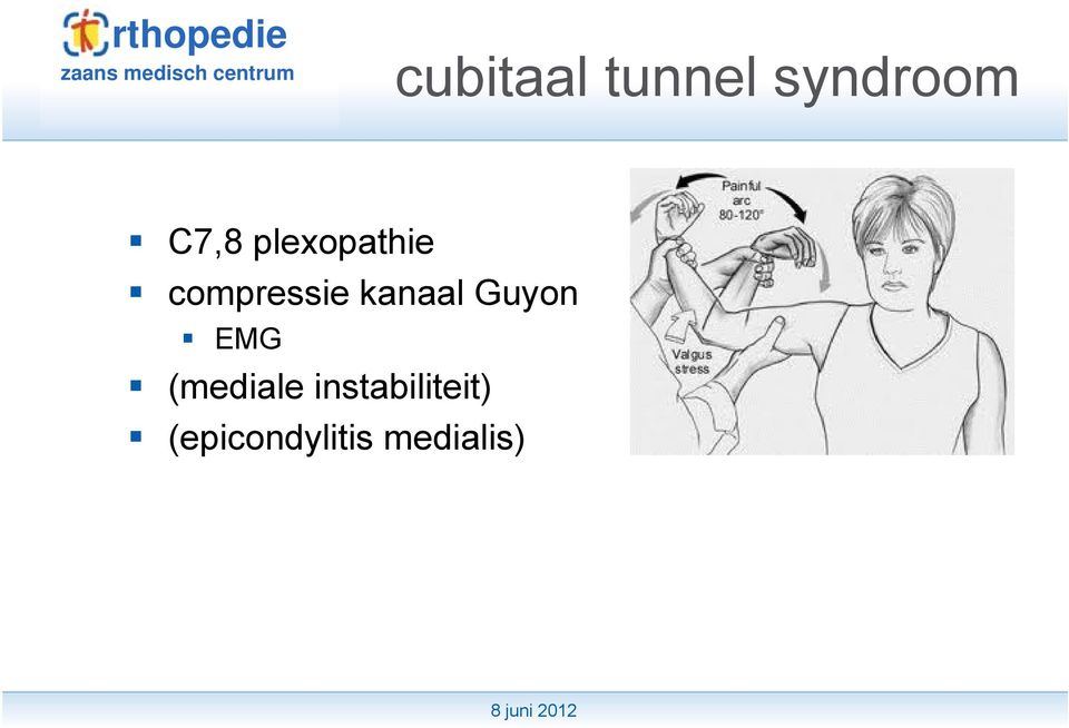 Guyon EMG (mediale