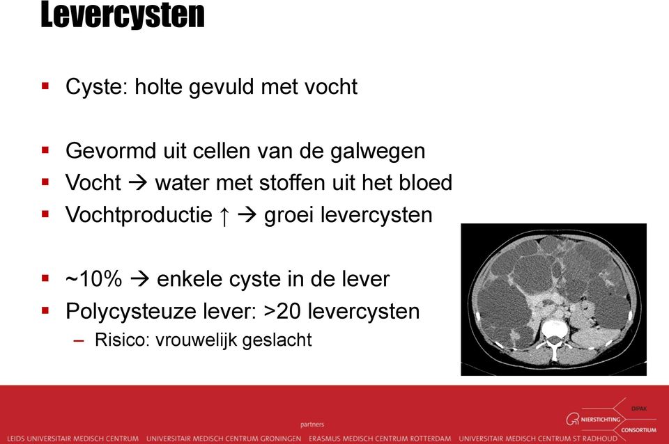 Vochtproductie groei levercysten ~10% enkele cyste in de