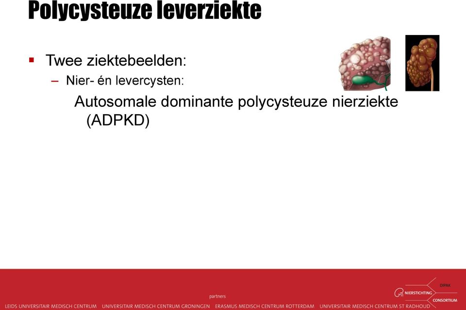 nierziekte (ADPKD) Enkel levercysten zonder