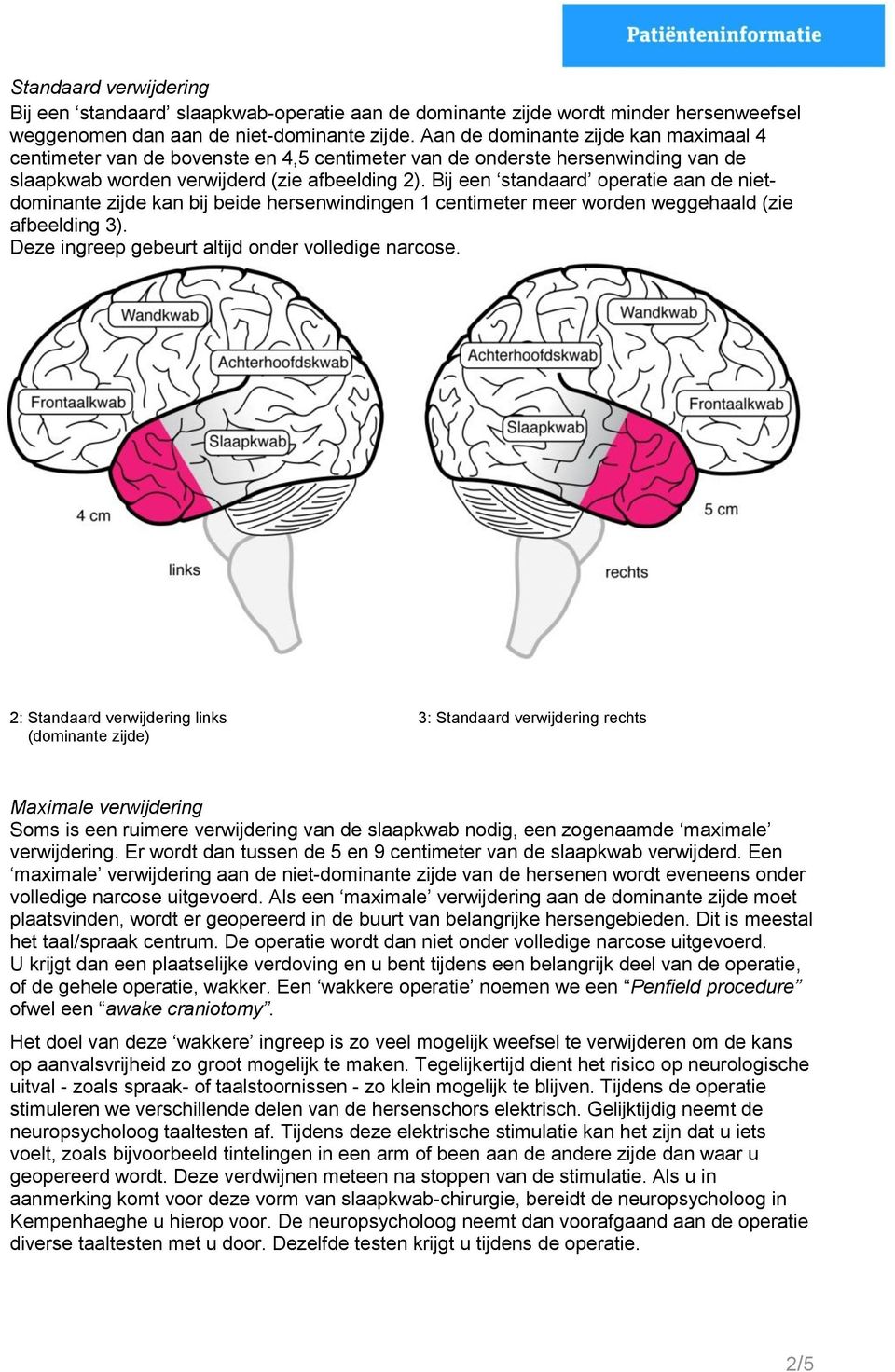 Bij een standaard operatie aan de nietdominante zijde kan bij beide hersenwindingen 1 centimeter meer worden weggehaald (zie afbeelding 3). Deze ingreep gebeurt altijd onder volledige narcose.