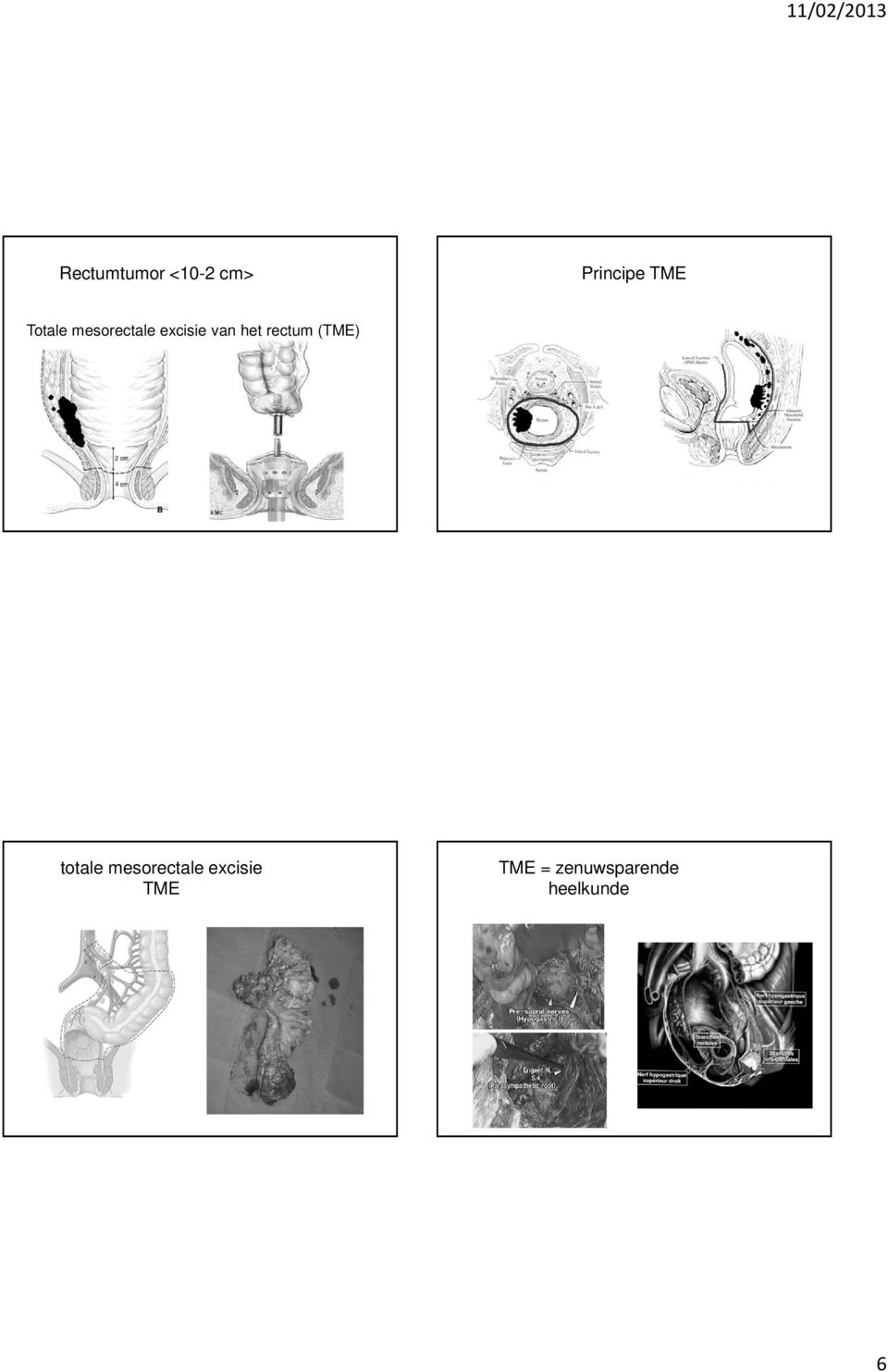 rectum (TME) totale mesorectale