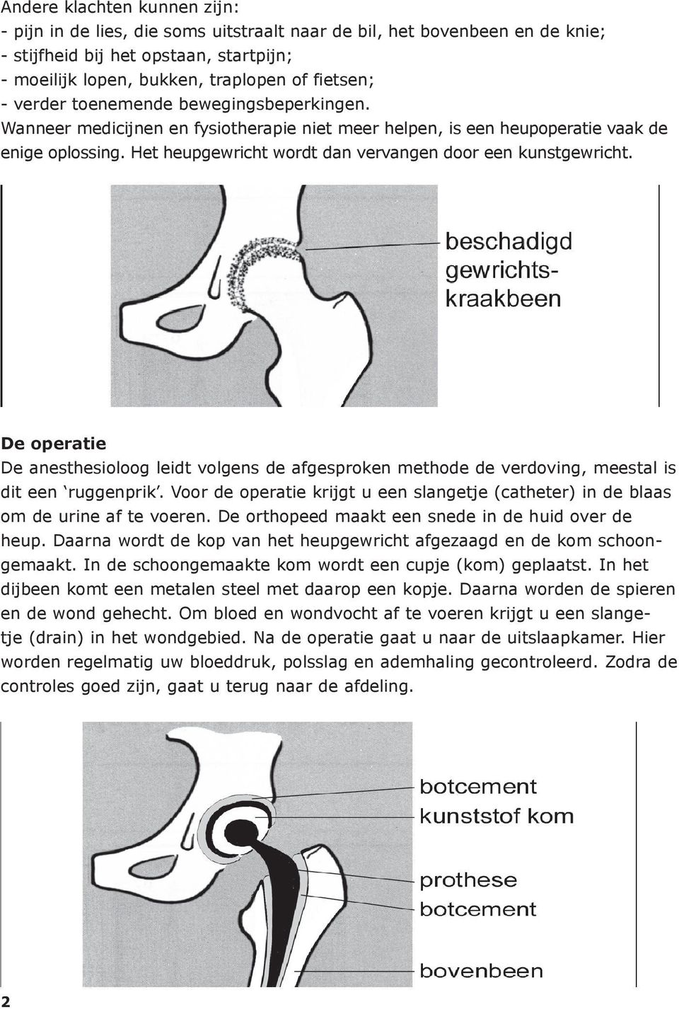 De operatie De anesthesioloog leidt volgens de afgesproken methode de verdoving, meestal is dit een ruggenprik. Voor de operatie krijgt u een slangetje (catheter) in de blaas om de urine af te voeren.