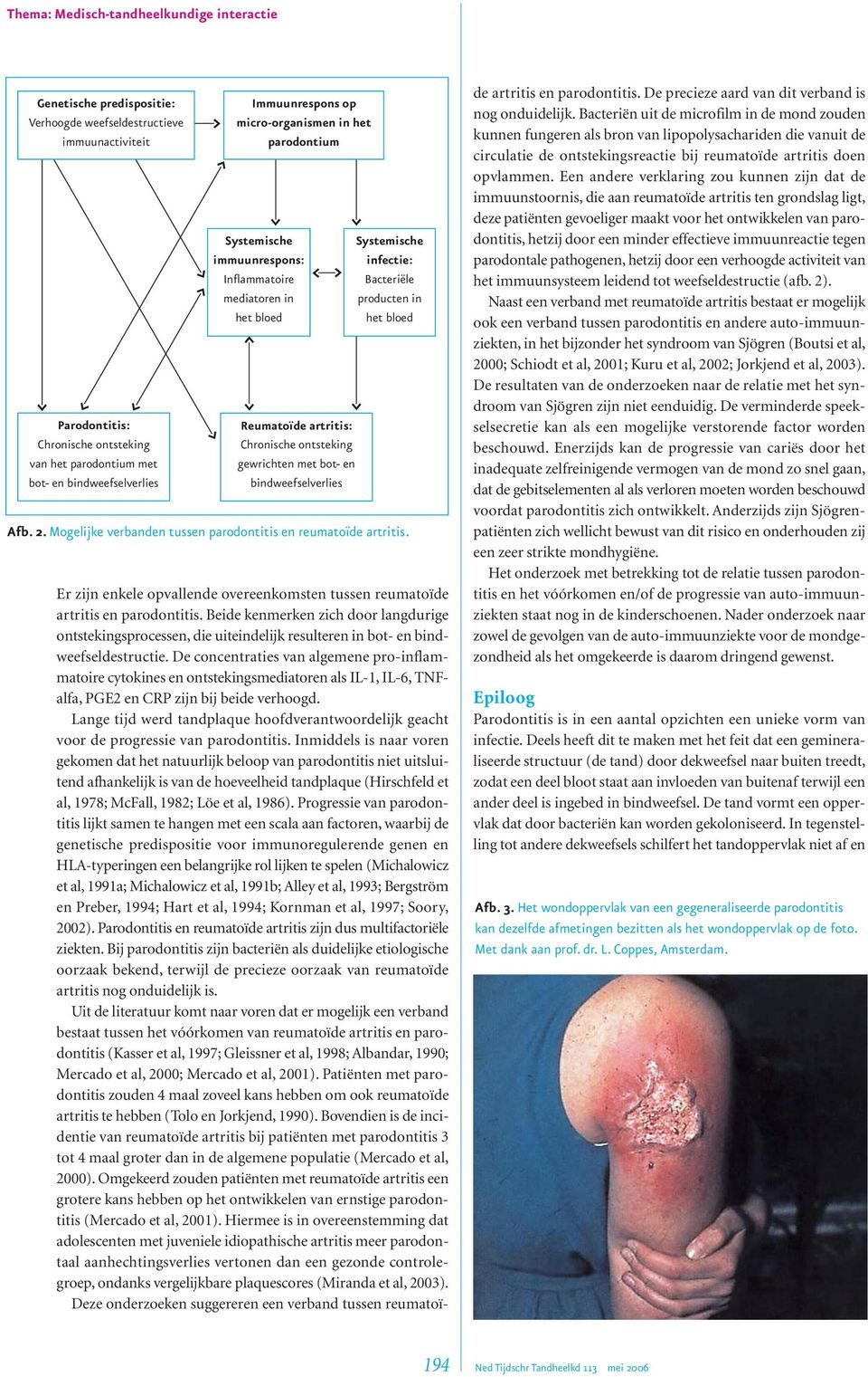en bindweefselverlies Systemische infectie: Bacteriële producten in het bloed Afb. 2. Mogelijke verbanden tussen parodontitis en reumatoïde artritis.