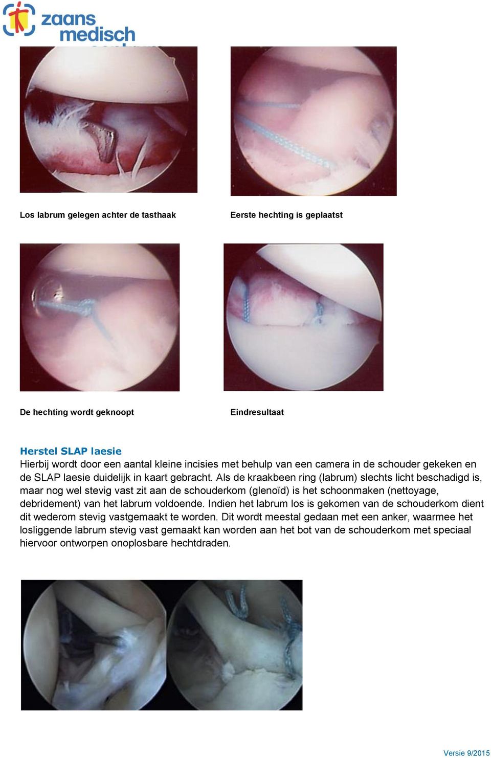 Als de kraakbeen ring (labrum) slechts licht beschadigd is, maar nog wel stevig vast zit aan de schouderkom (glenoïd) is het schoonmaken (nettoyage, debridement) van het labrum voldoende.