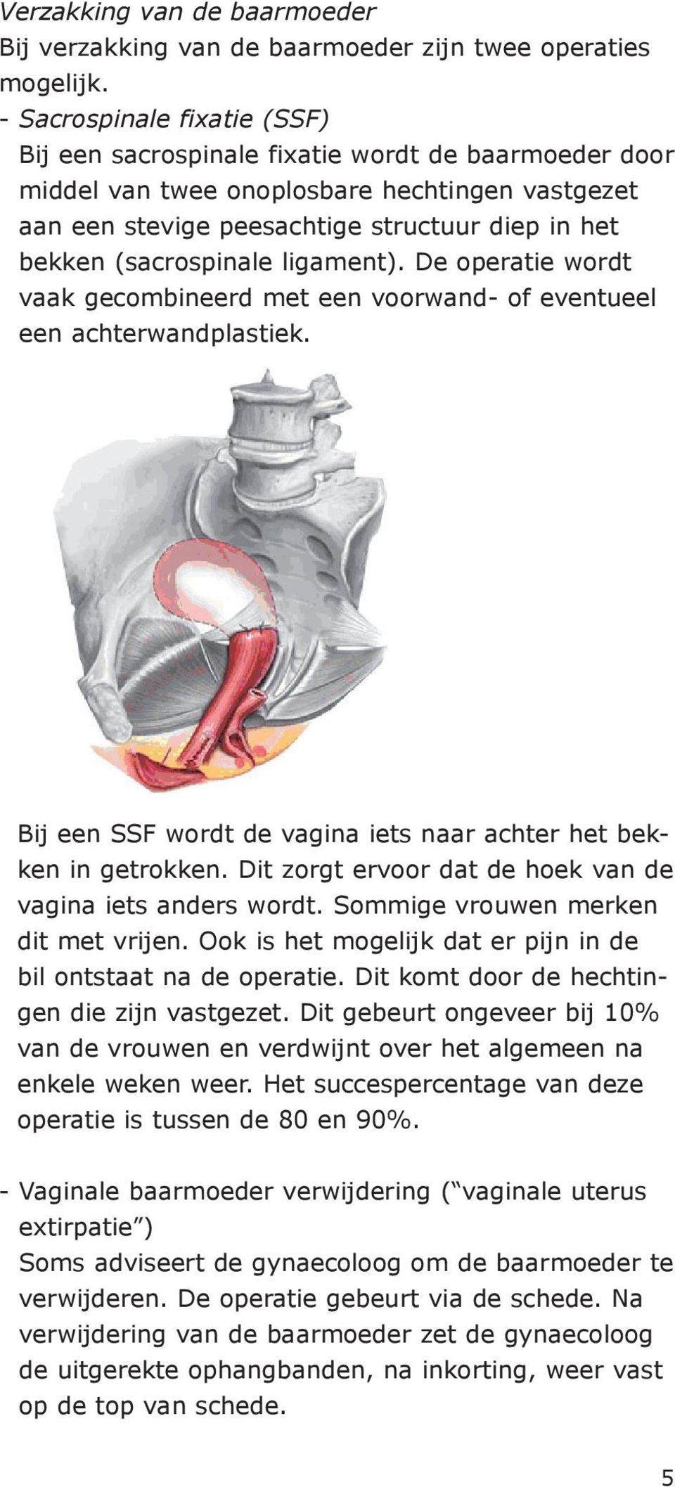 (sacrospinale ligament). De operatie wordt vaak gecombineerd met een voorwand- of eventueel een achterwandplastiek. Bij een SSF wordt de vagina iets naar achter het bekken in getrokken.