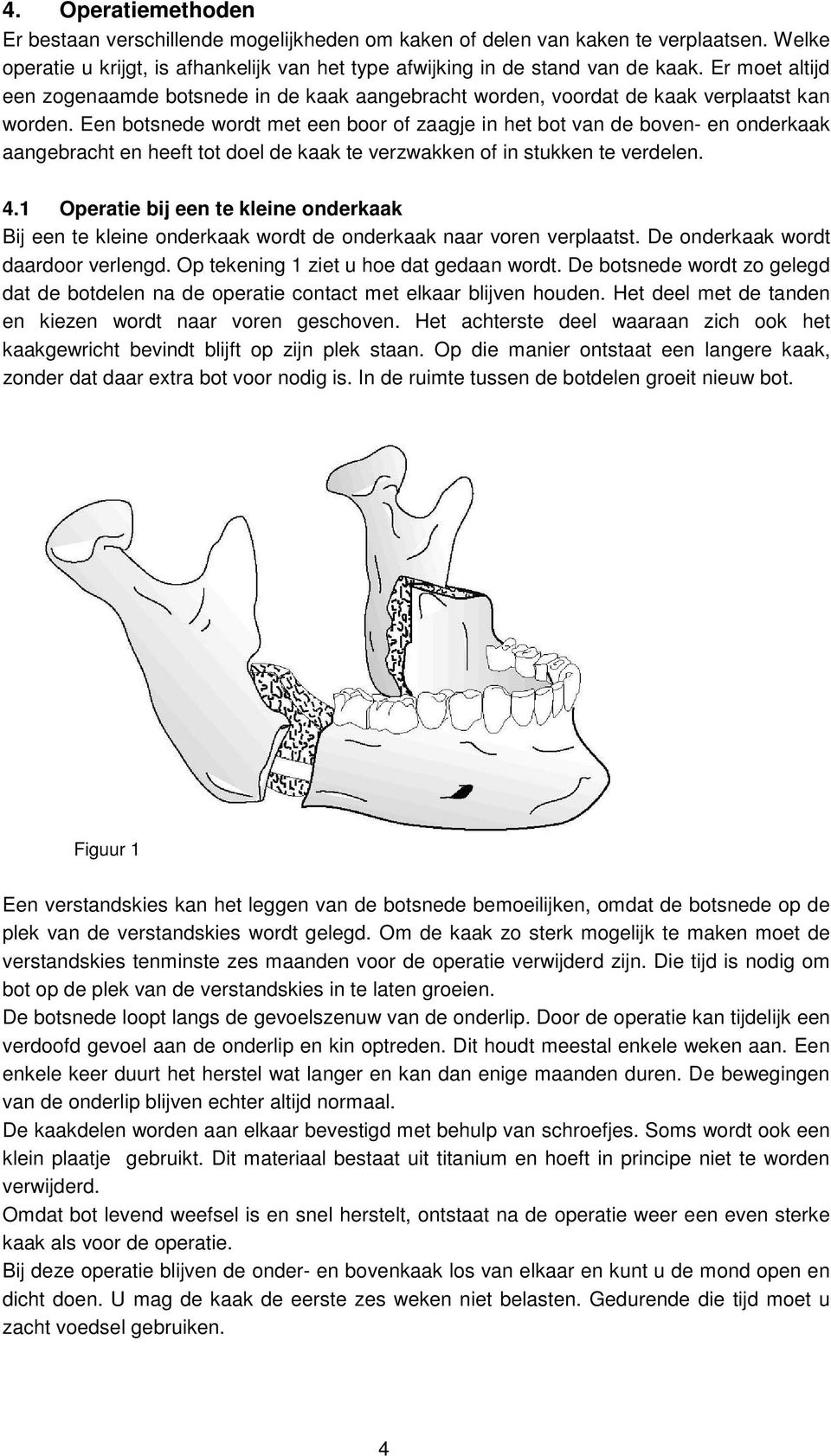 Een botsnede wordt met een boor of zaagje in het bot van de boven- en onderkaak aangebracht en heeft tot doel de kaak te verzwakken of in stukken te verdelen. 4.