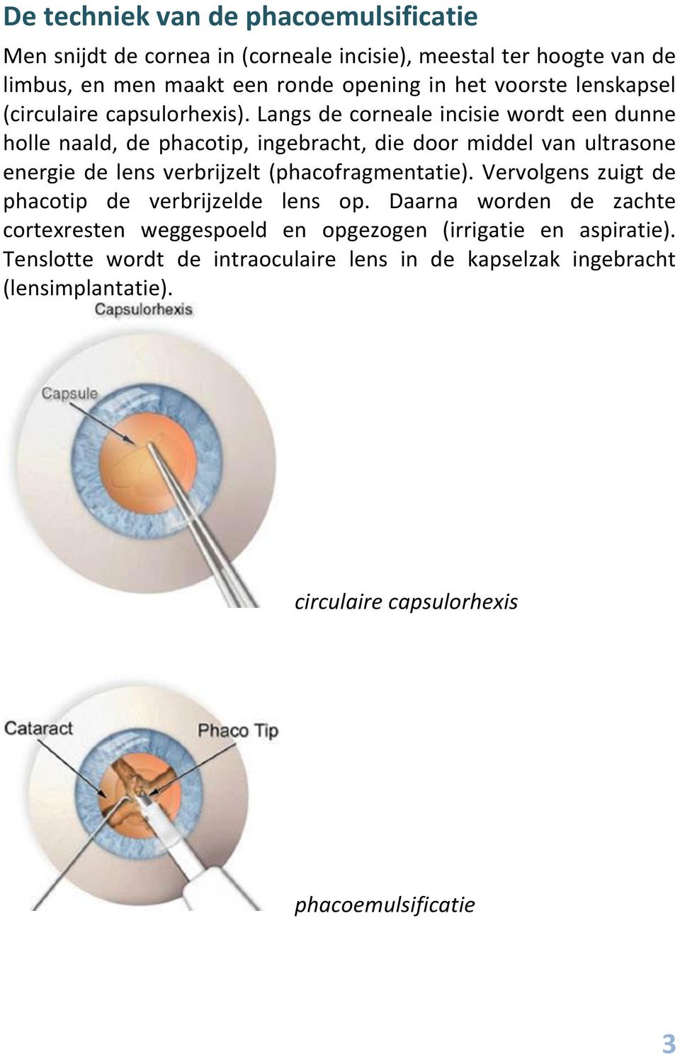 Langs de corneale incisie wordt een dunne holle naald, de phacotip, ingebracht, die door middel van ultrasone energie de lens verbrijzelt (phacofragmentatie).