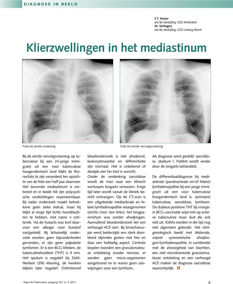 24-jarige immigrant uit een voor tuberculose hoogendemisch land blijkt de thoraxfoto te zijn veranderd ten opzichte van de foto een half jaar daarvoor.