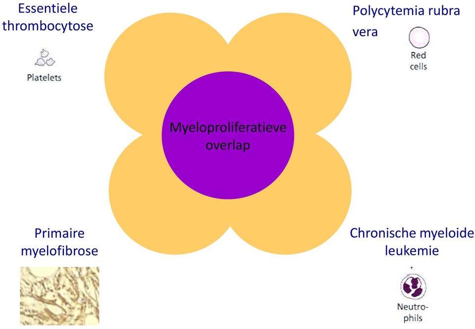 Myeloproliferatieve overlap