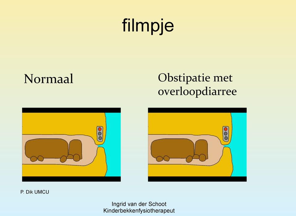 Obstipatie met