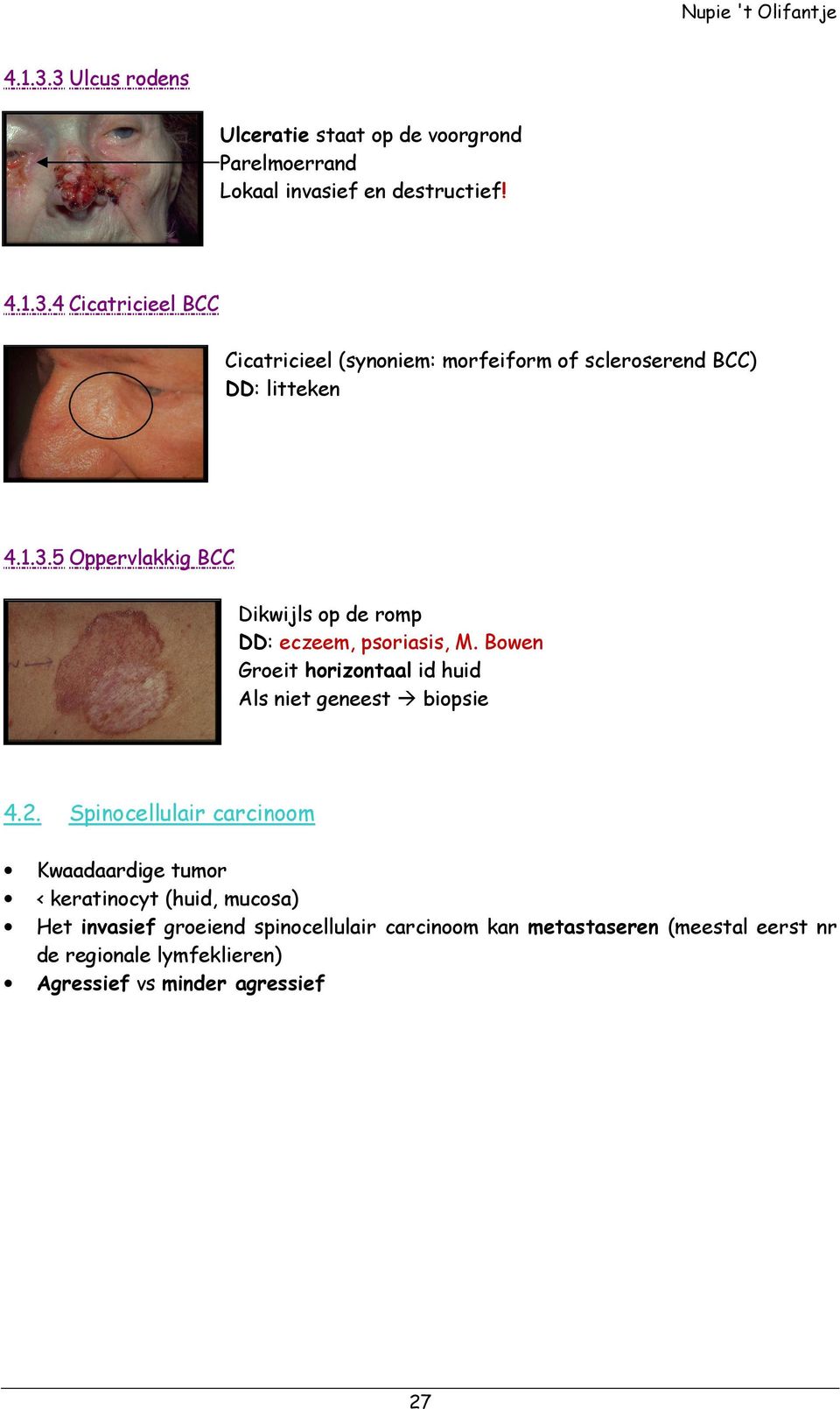 Spinocellulair carcinoom Kwaadaardige tumor < keratinocyt (huid, mucosa) Het invasief groeiend spinocellulair carcinoom kan