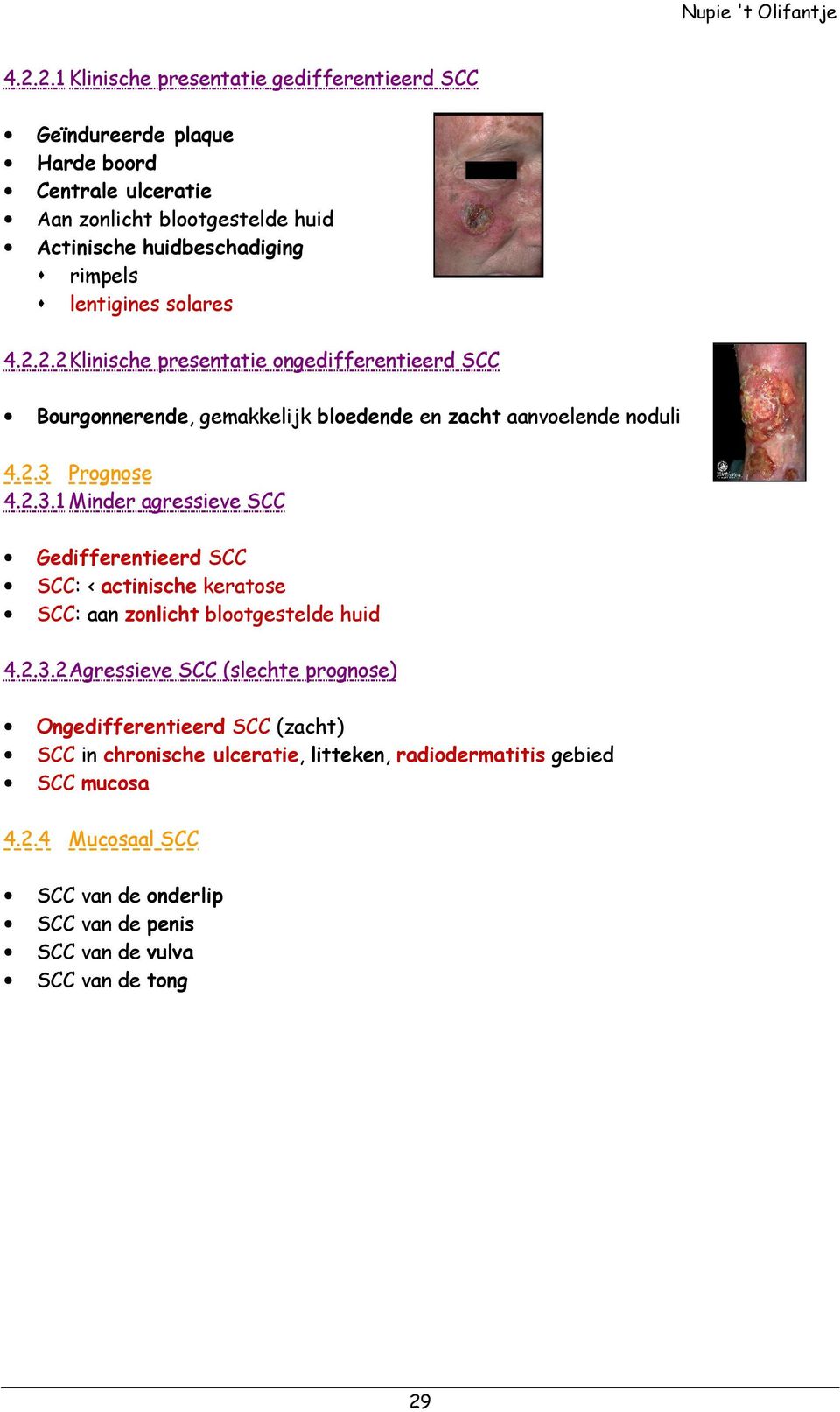 Prognose 4.2.3.1 Minder agressieve SCC Gedifferentieerd SCC SCC: < actinische keratose SCC: aan zonlicht blootgestelde huid 4.2.3.2 Agressieve SCC (slechte prognose) Ongedifferentieerd SCC (zacht) SCC in chronische ulceratie, litteken, radiodermatitis gebied SCC mucosa 4.