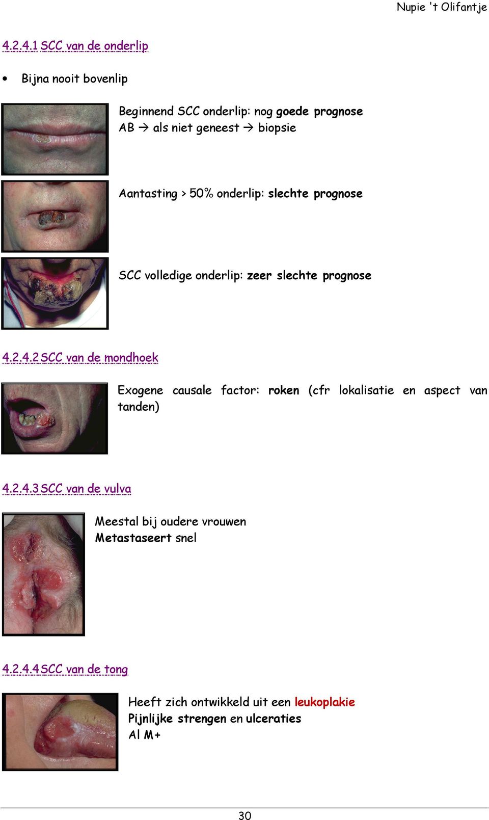 2.4.2 SCC van de mondhoek Exogene causale factor: roken (cfr lokalisatie en aspect van tanden) 4.2.4.3 SCC van de vulva Meestal bij oudere vrouwen Metastaseert snel 4.