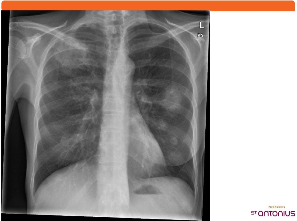 angio-invasieve aspergillus wv voriconazol Na CHOEP II: - Opname ivm haemorrhagische cystitis