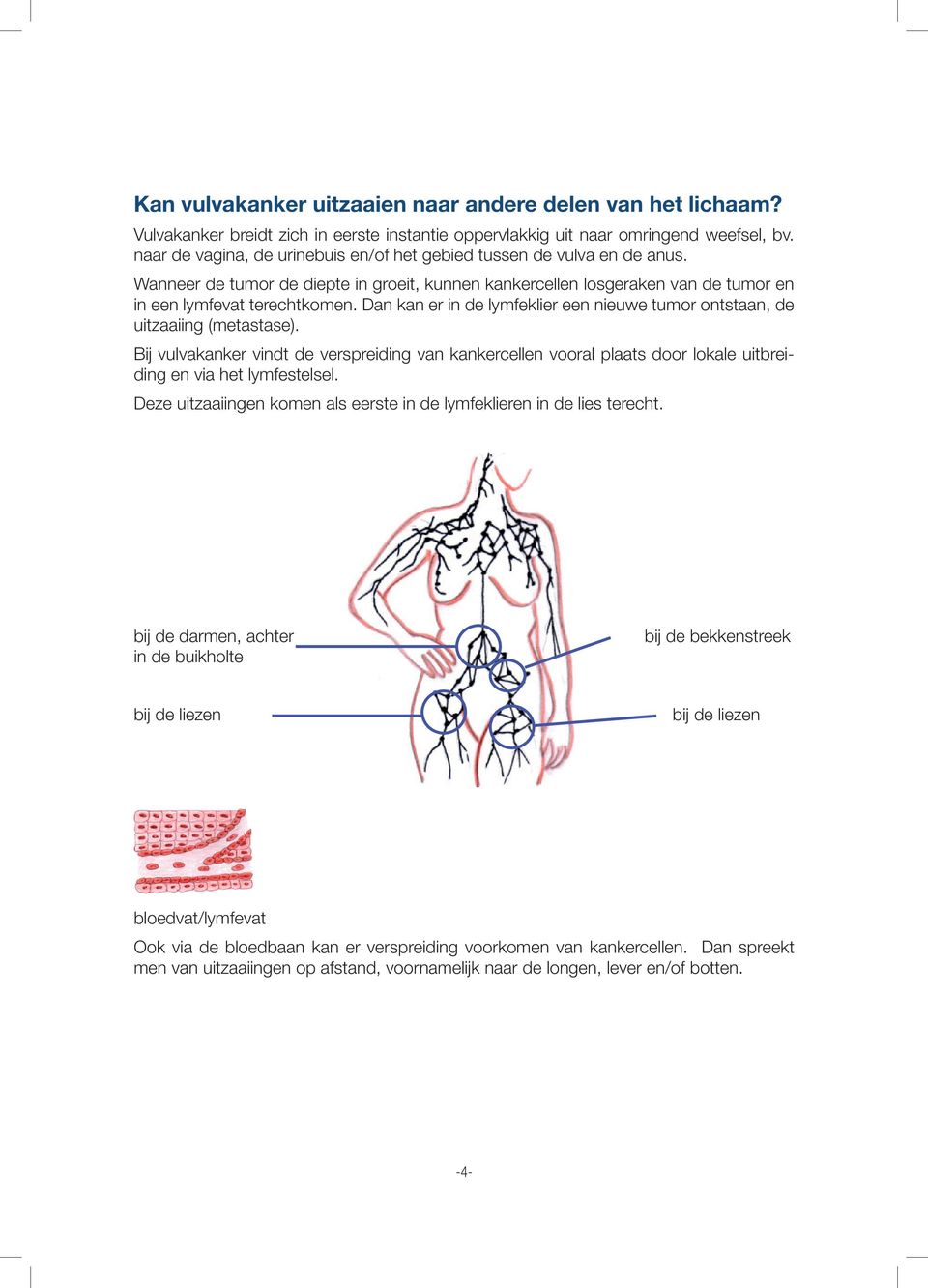 Dan kan er in de lymfeklier een nieuwe tumor ontstaan, de uitzaaiing (metastase). Bij vulvakanker vindt de verspreiding van kankercellen vooral plaats door lokale uitbreiding en via het lymfestelsel.