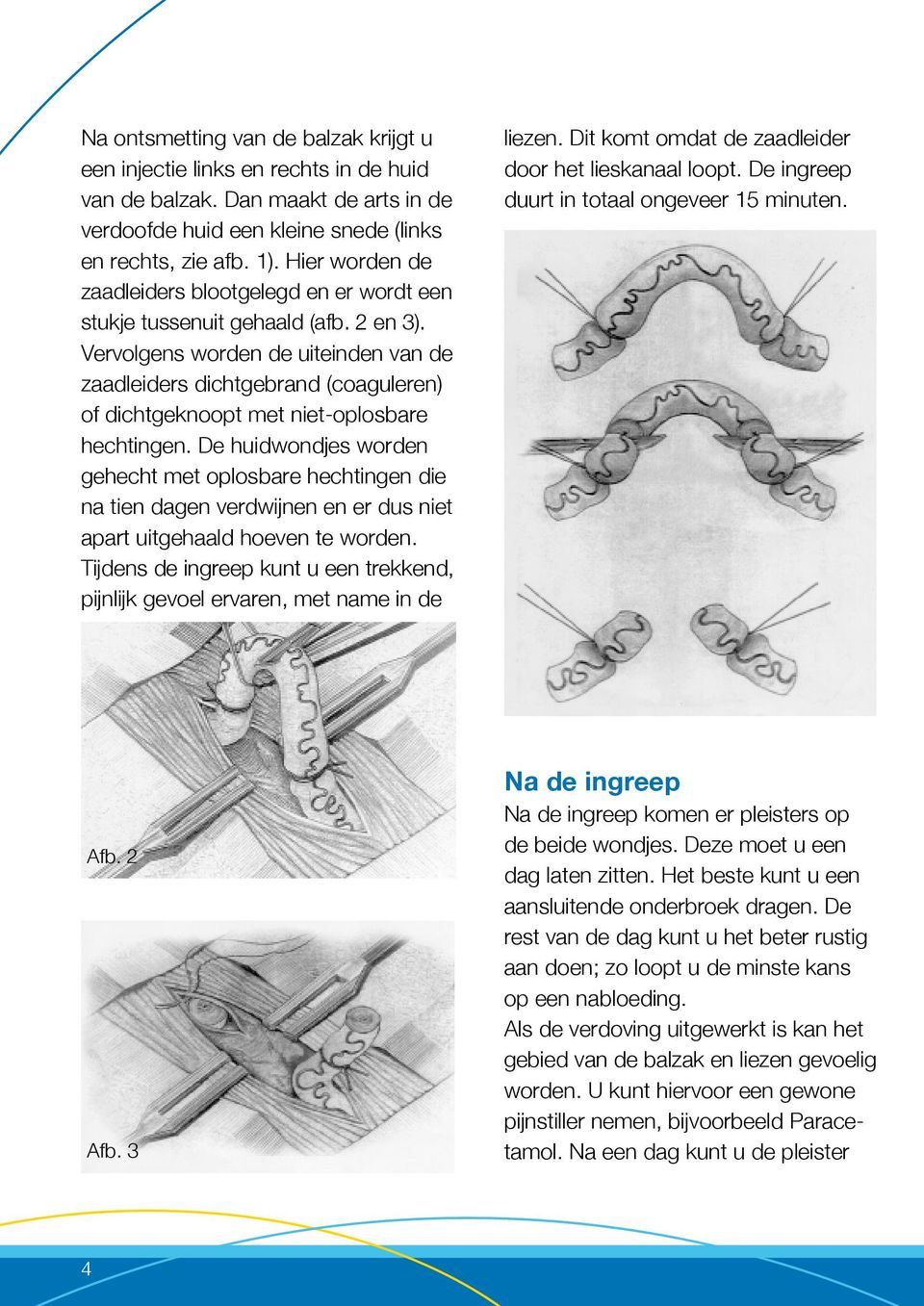 Vervolgens worden de uiteinden van de zaadleiders dichtgebrand (coaguleren) of dichtgeknoopt met niet-oplosbare hechtingen.