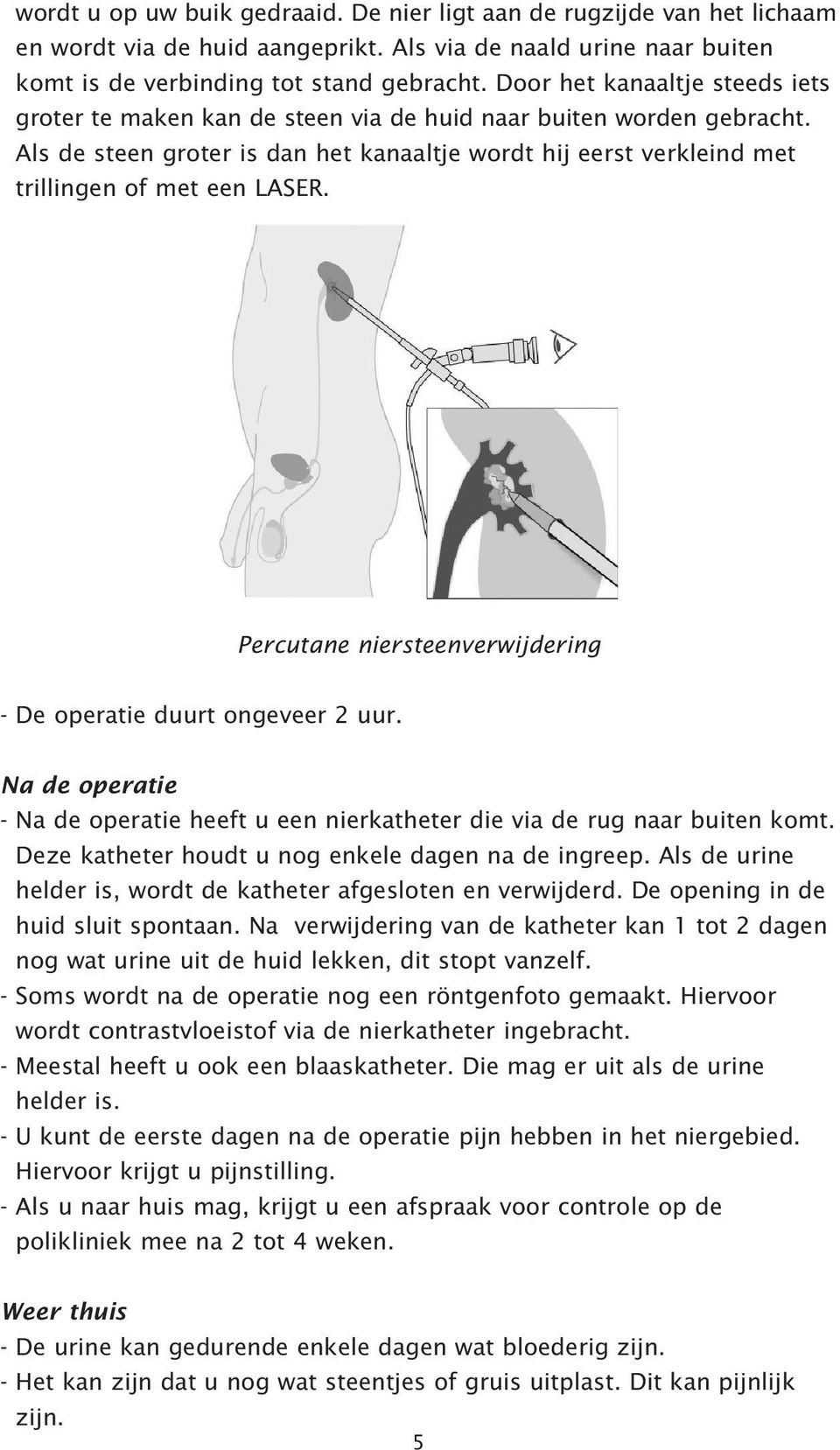 Percutane niersteenverwijdering - De operatie duurt ongeveer 2 uur. Na de operatie - Na de operatie heeft u een nierkatheter die via de rug naar buiten komt.