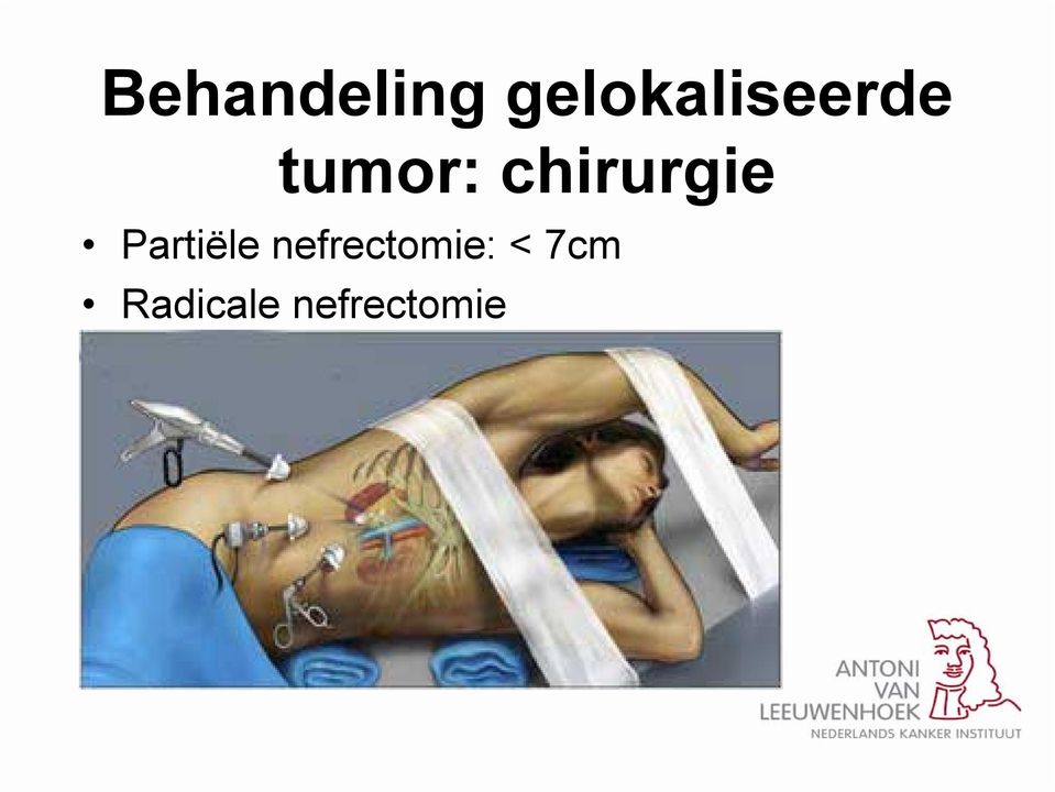 chirurgie Partiële