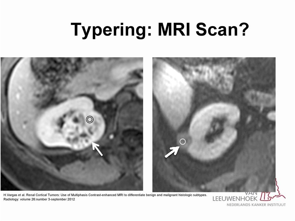 Contrast-enhanced MRI to differentiate benign and