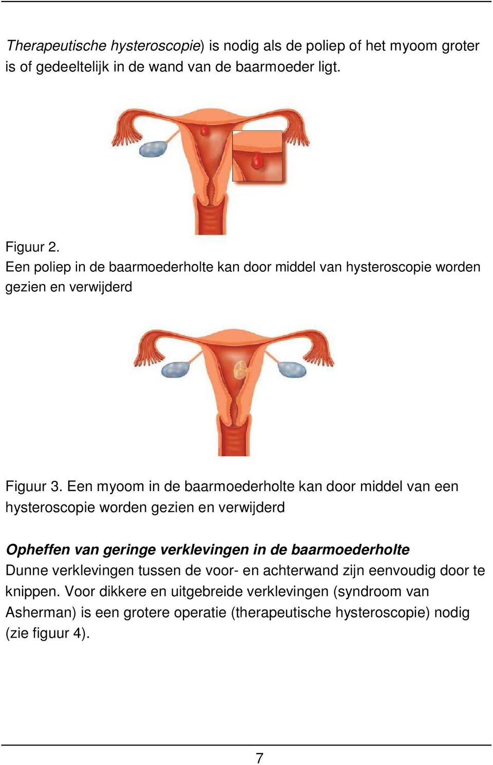 Een myoom in de baarmoederholte kan door middel van een hysteroscopie worden gezien en verwijderd Opheffen van geringe verklevingen in de baarmoederholte