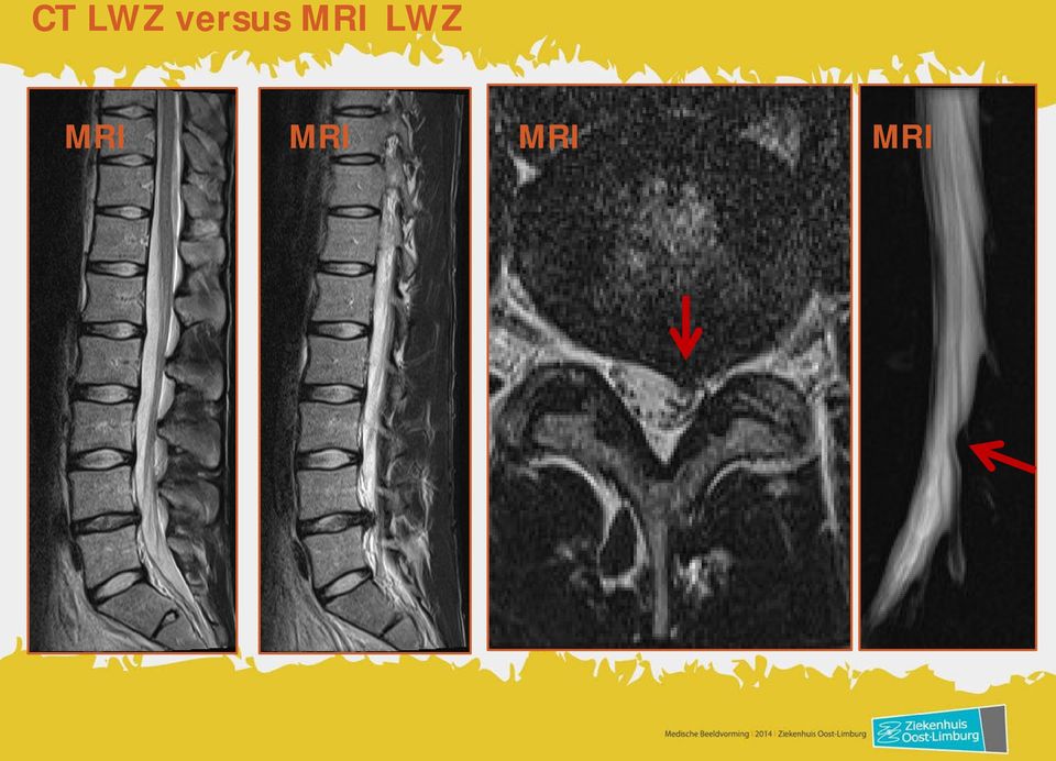 MRI LWZ