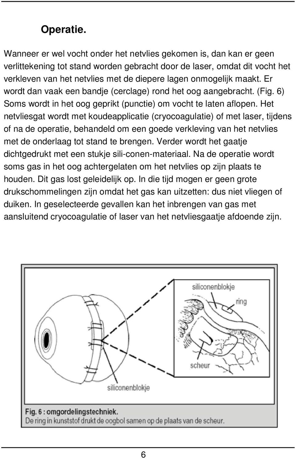 onmogelijk maakt. Er wordt dan vaak een bandje (cerclage) rond het oog aangebracht. (Fig. 6) Soms wordt in het oog geprikt (punctie) om vocht te laten aflopen.