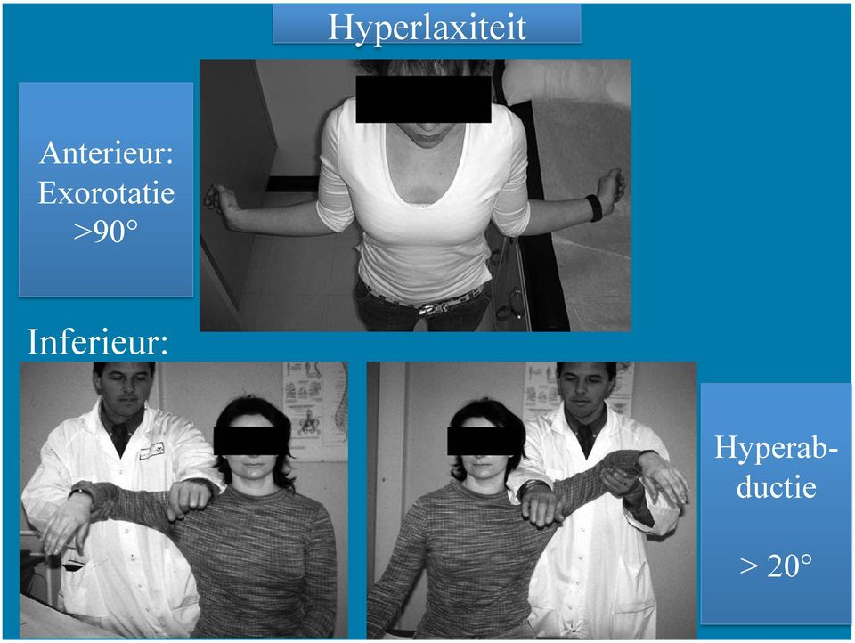 1 External rotation of more than 85 with the arm at the side demonstrates anterior shoulder hyperlaxity. months follow-up.