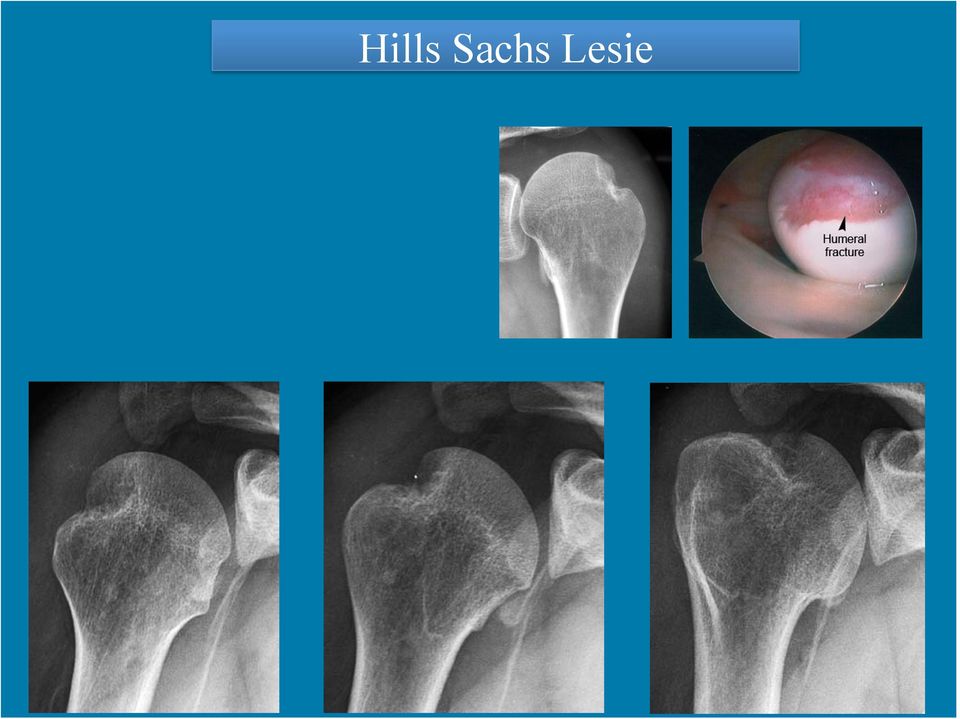 Evaluation of Labral and Ligamentous Lesions Arthroscopic examination was used to evaluate the extent of the labral detachment around the glenoid, the degree of capsular laxity, and the quality of