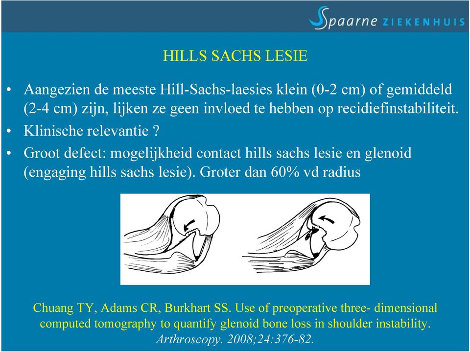 H Groot defect: mogelijkheid contact hills sachs lesie en glenoid (engaging hills sachs lesie).