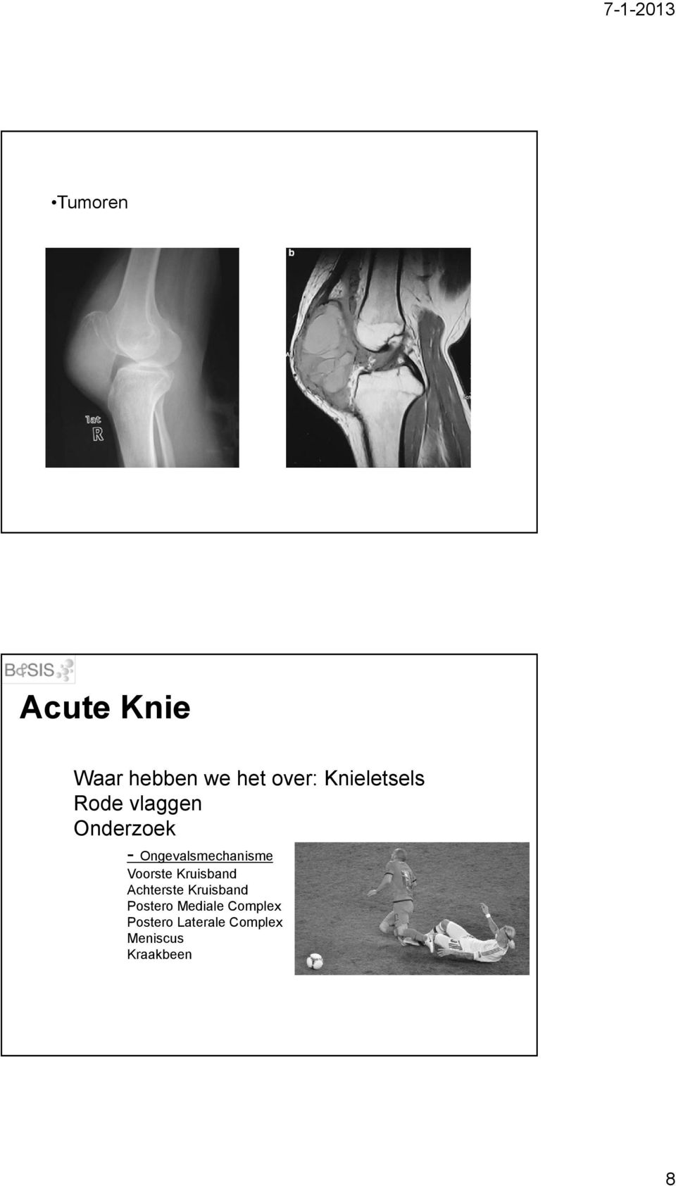 Ongevalsmechanisme Voorste Kruisband Achterste