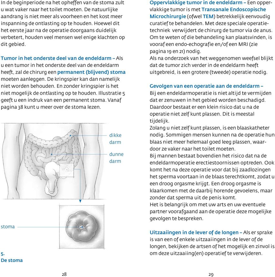 Tumor in het onderste deel van de endeldarm Als u een tumor in het onderste deel van de endeldarm heeft, zal de chirurg een permanent (blijvend) stoma moeten aanleggen.