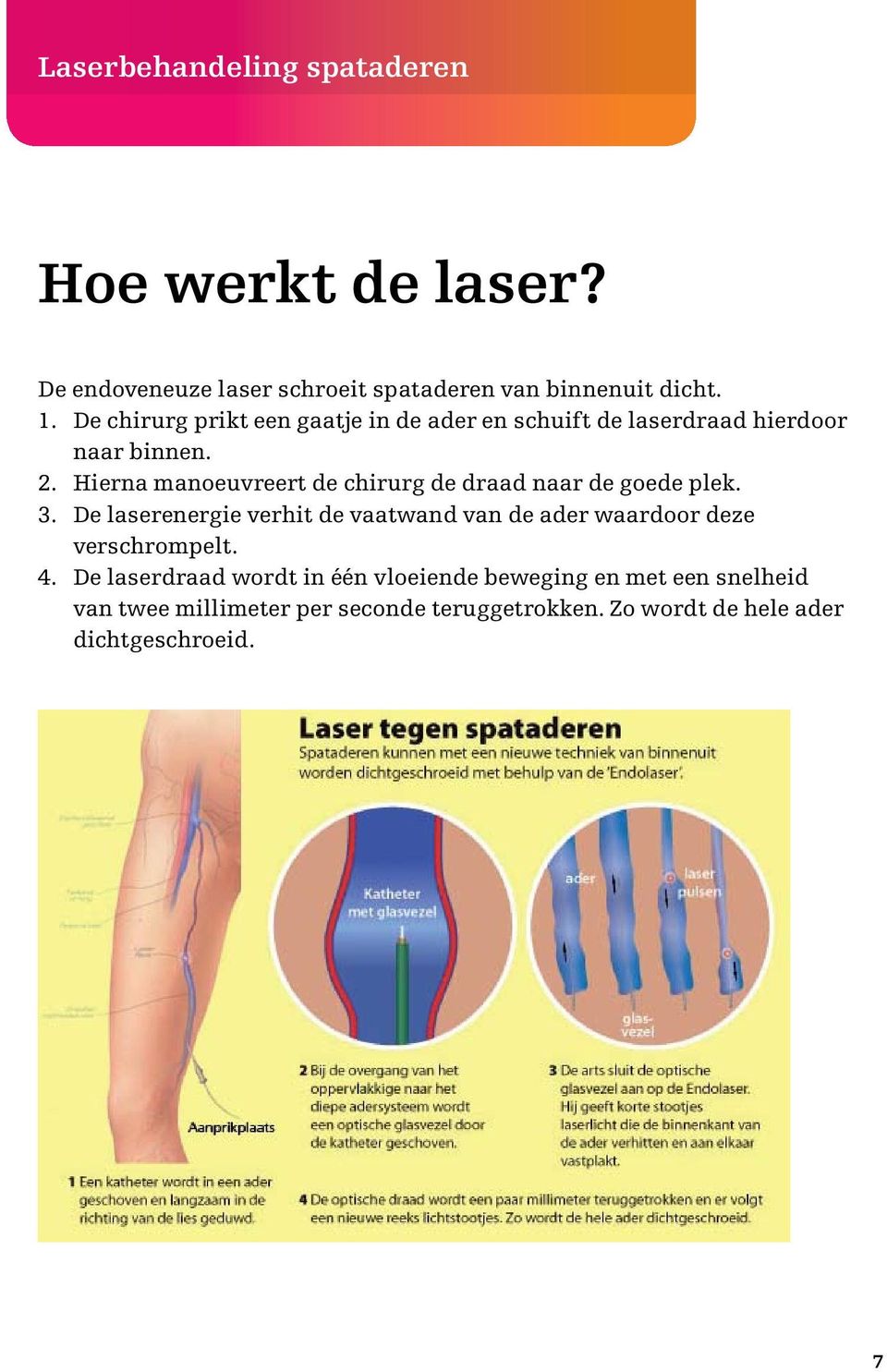 Hierna manoeuvreert de chirurg de draad naar de goede plek. 3.