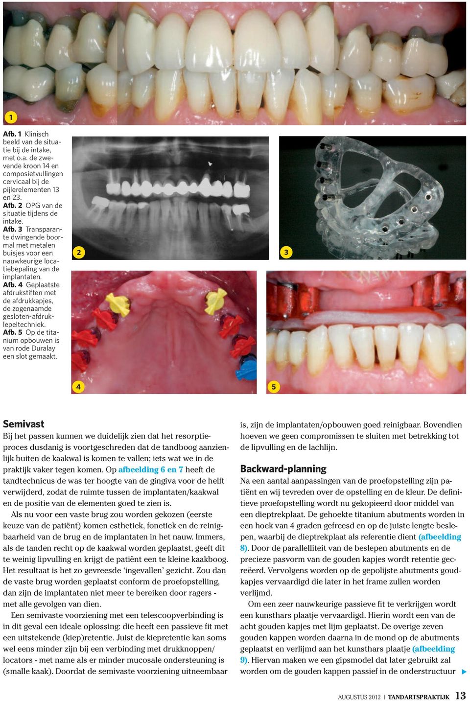2 3 4 5 Semivast Bij het passen kunnen we duidelijk zien dat het resorptieproces dusdanig is voortgeschreden dat de tandboog aanzienlijk buiten de kaakwal is komen te vallen; iets wat we in de