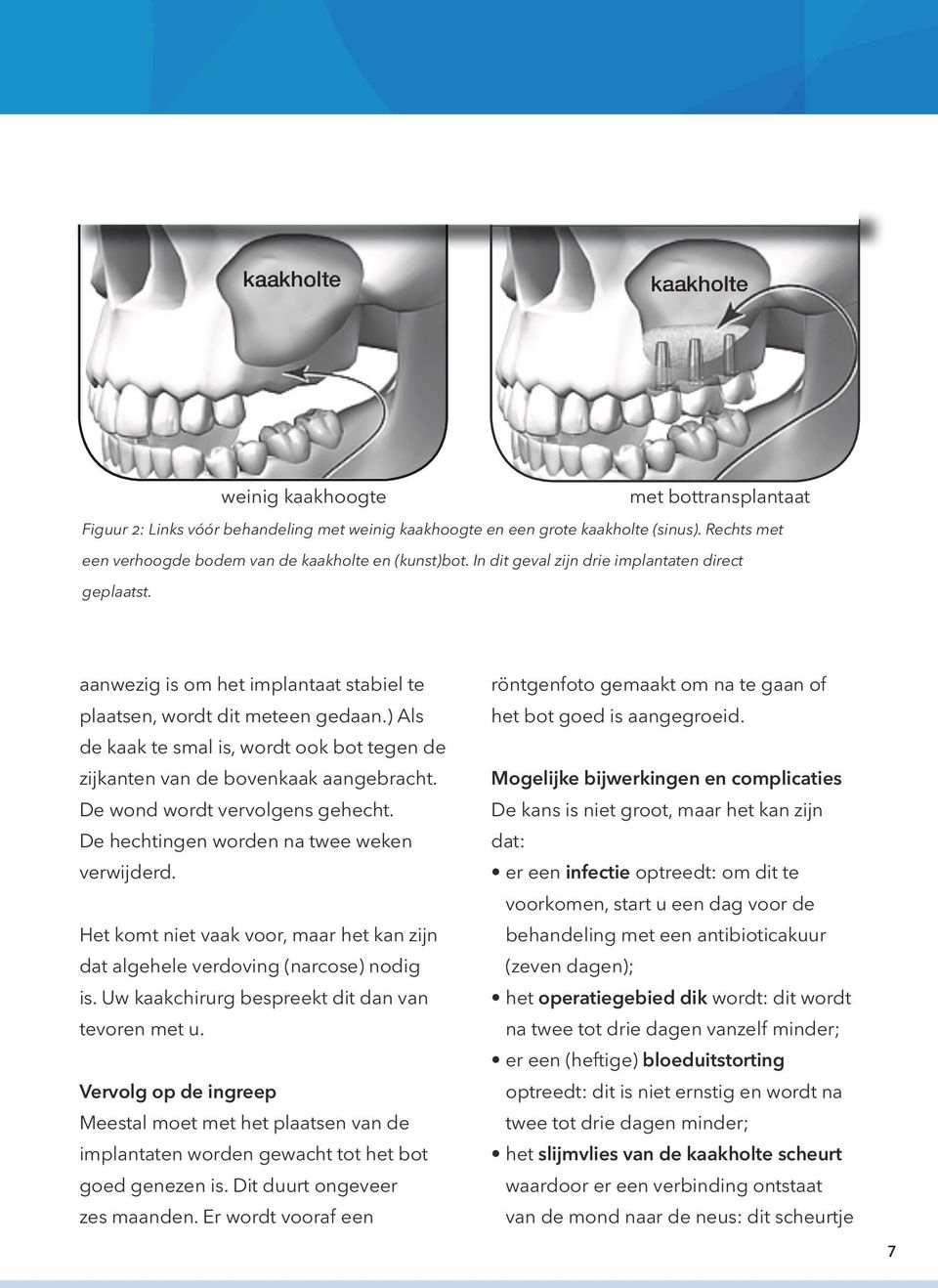 ) Als de kaak te smal is, wordt ook bot tegen de zijkanten van de bovenkaak aangebracht. De wond wordt vervolgens gehecht. De hechtingen worden na twee weken verwijderd.