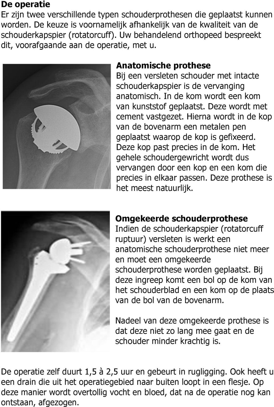 In de kom wordt een kom van kunststof geplaatst. Deze wordt met cement vastgezet. Hierna wordt in de kop van de bovenarm een metalen pen geplaatst waarop de kop is gefixeerd.