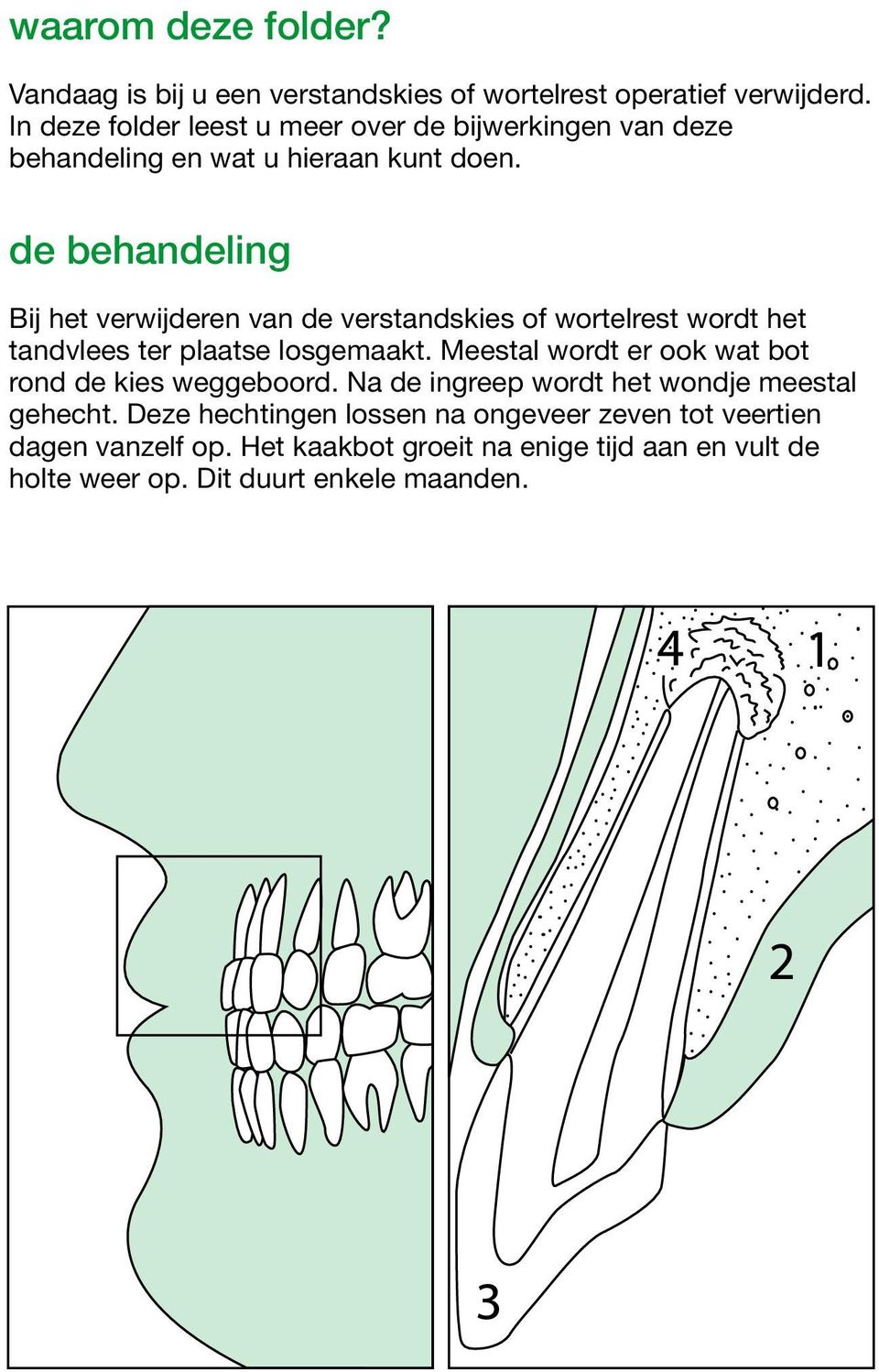 de behandeling Bij het verwijderen van de verstandskies of wortelrest wordt het tandvlees ter plaatse losgemaakt.